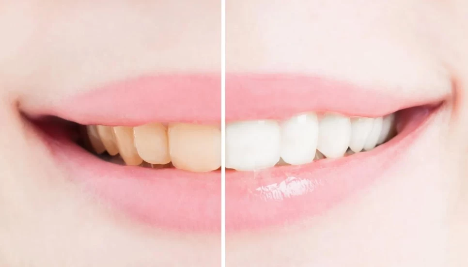 Can Rosemary Oil Whiten Teeth? A Scientific Review