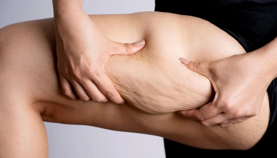 The Scientific Role of Rosemary Oil in Cellulite Treatment