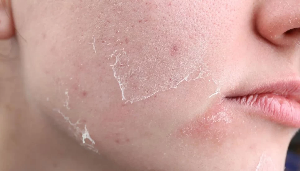 Natural Extracts for Dry Skin Care