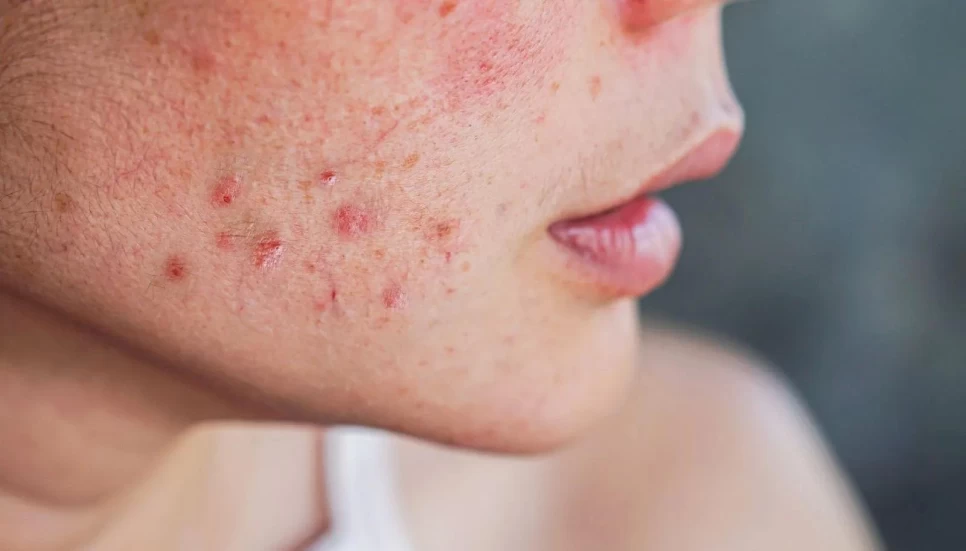 Herbal Solutions for Skin Spots